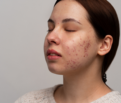 Acne & Acne Scars